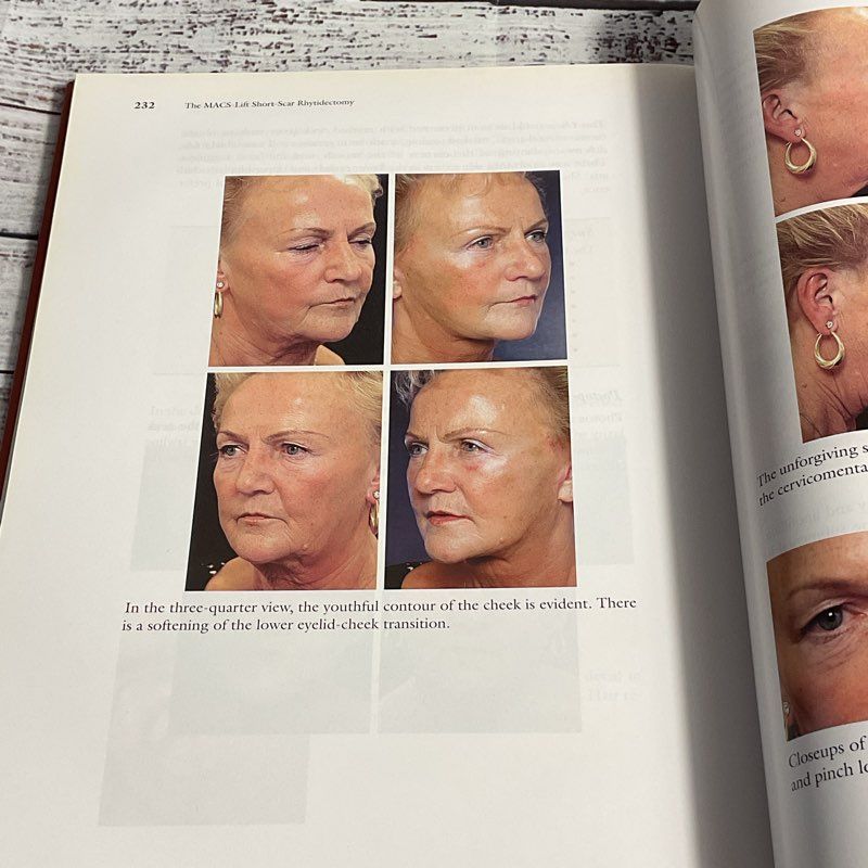 The Macs Lift Short Scar Rhytidectomy Hardcover By Tonnard & Verpaele 2004